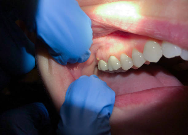 Best Emergency Dentist for Knocked-Out Tooth in Amherst, VA