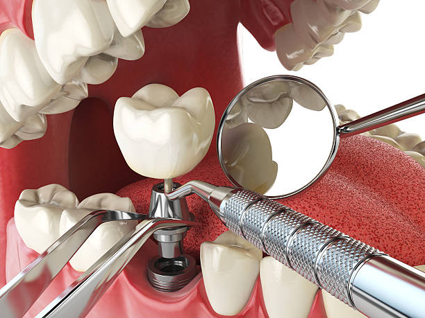 Best Emergency Dentist for Lost Fillings or Crowns in Amherst, VA